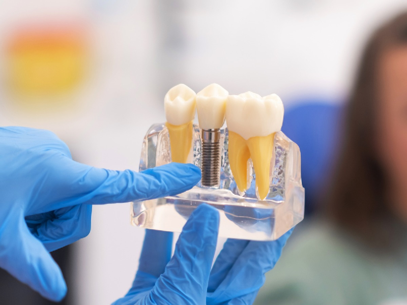 Dental Implants